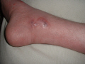 A nasty burn to the ankle, greatly healed